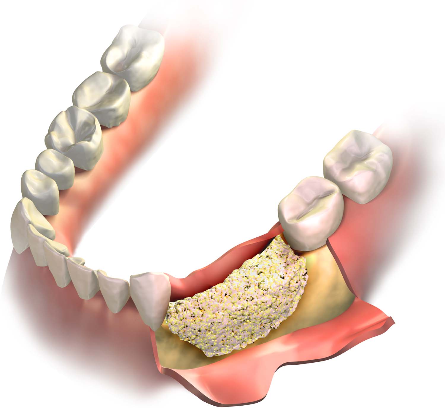 bone grafting