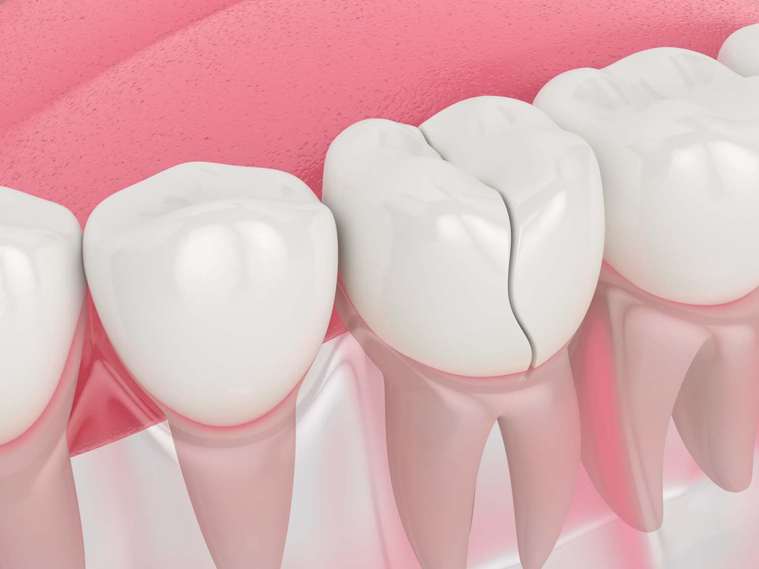 cracked teeth treatment