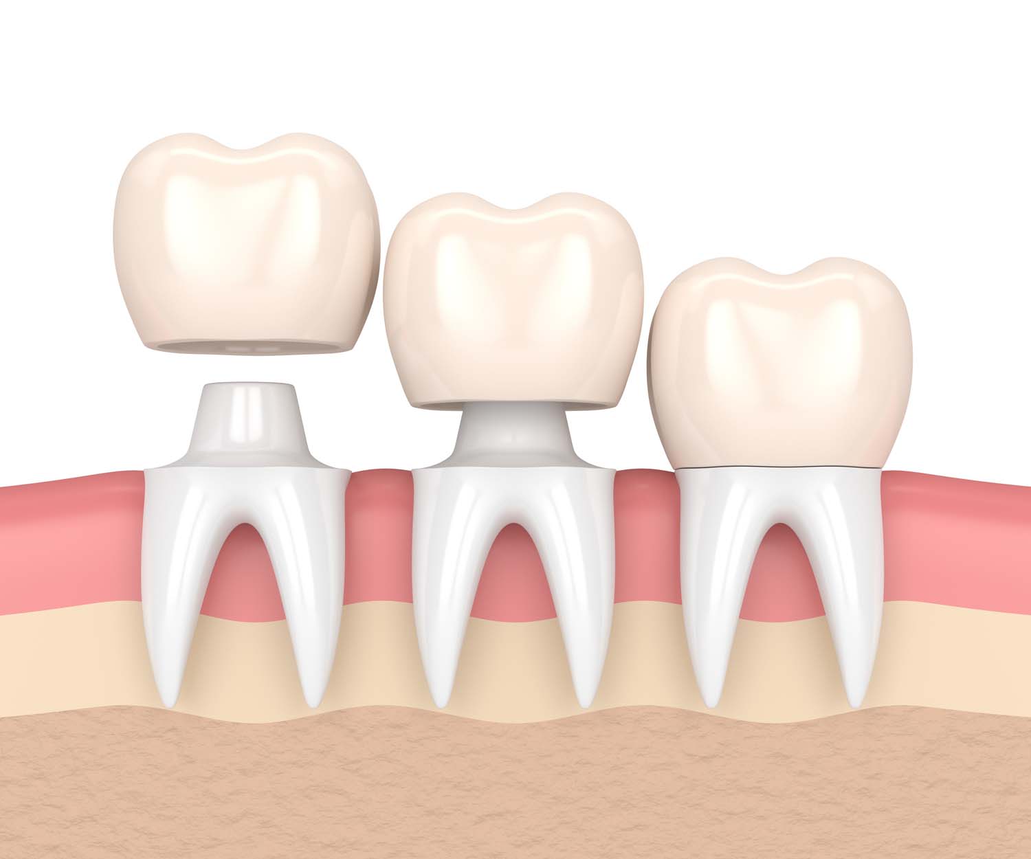 dental crowns