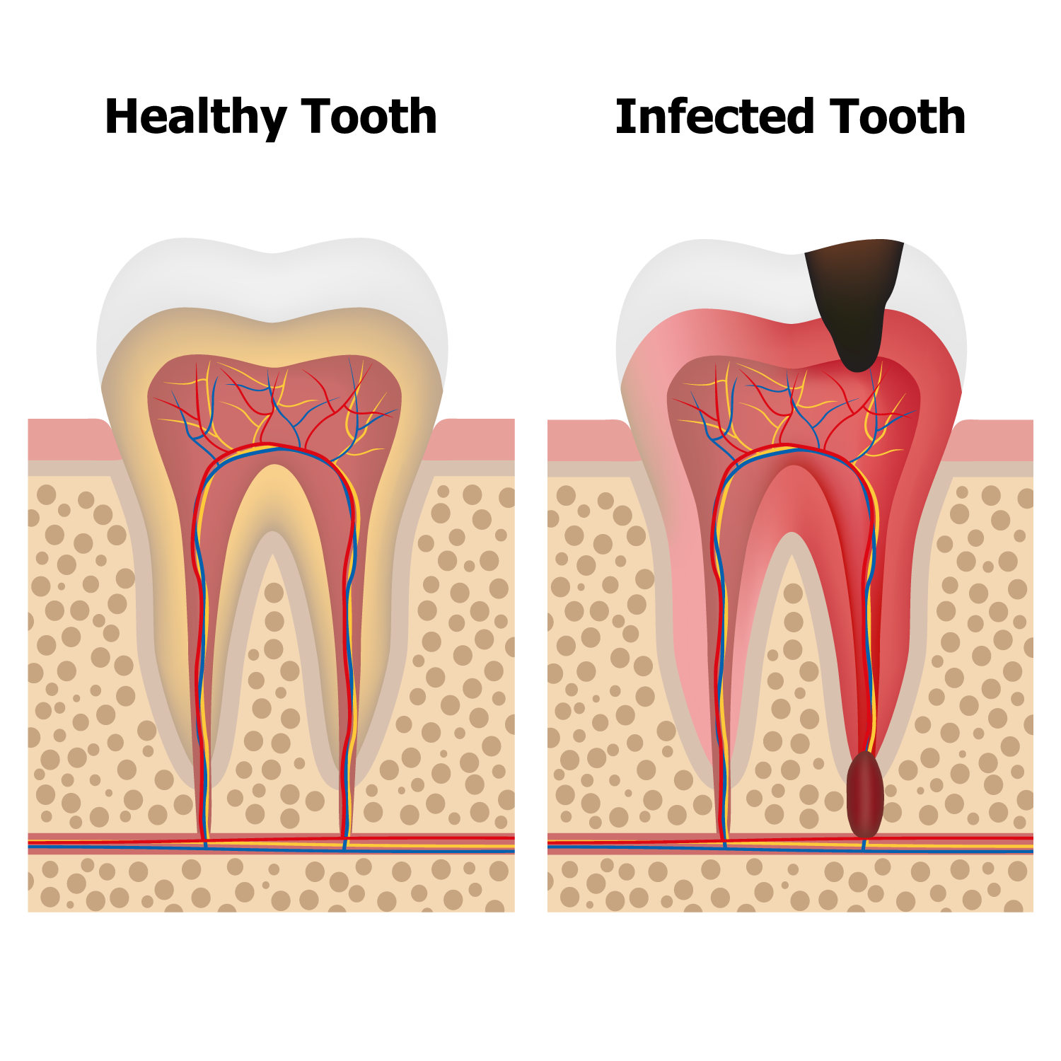 root-canal-treatment