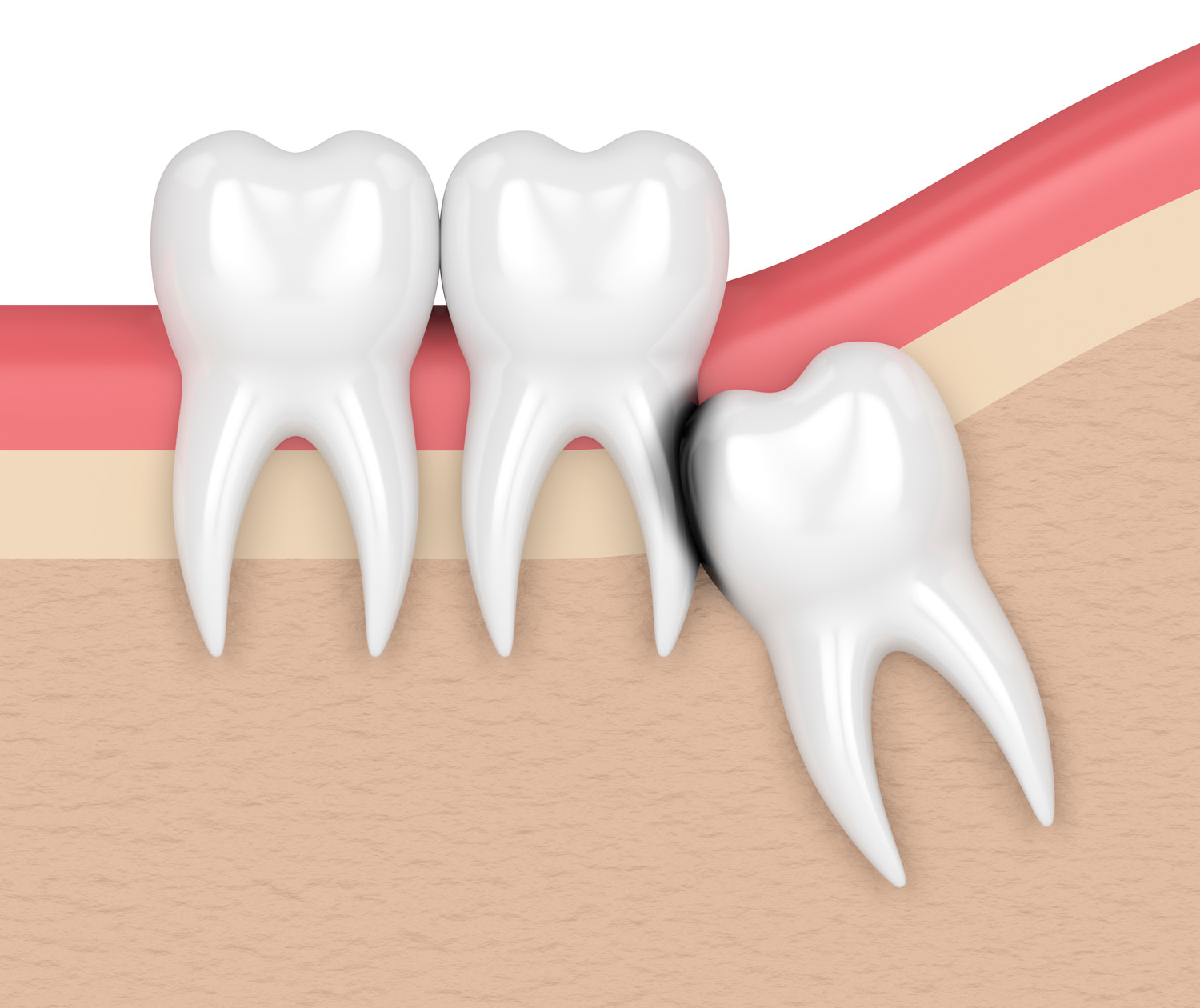 wisdom tooth extraction